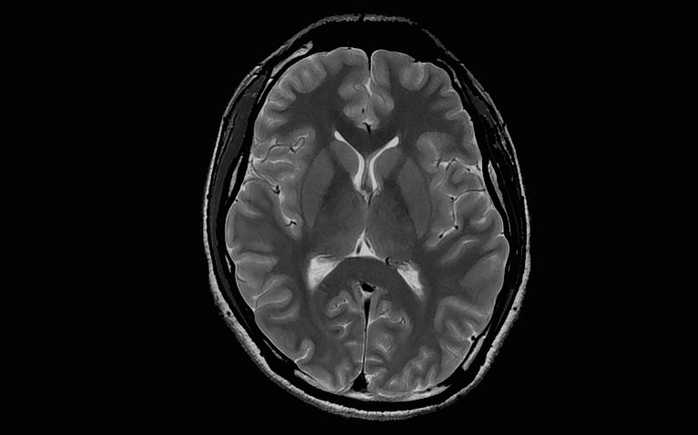 Exámenes de resonancia magnetica cerebro